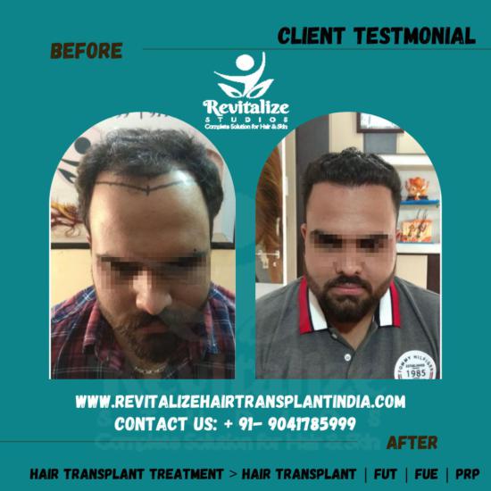 Hair Transplant In Jalandhar Photo Album By Karamjot Kaur