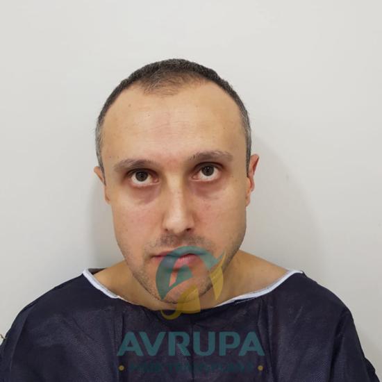 Liver transplant case study assignment picture