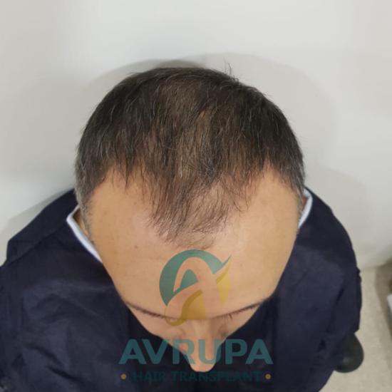 Transplant case study image