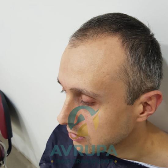 Transplant-related complication case study image