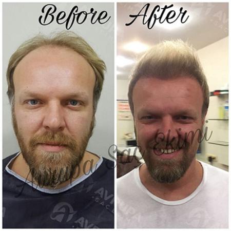 Hair Transplant Before And After 3600 Grafts 2019 Clinic Advisor