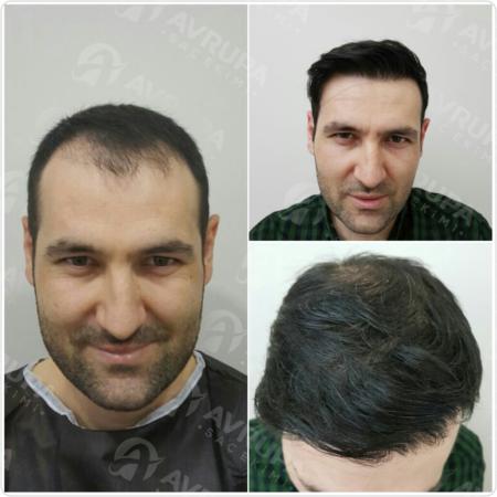 My hair transplant surgery - Tae Smurf Smurf